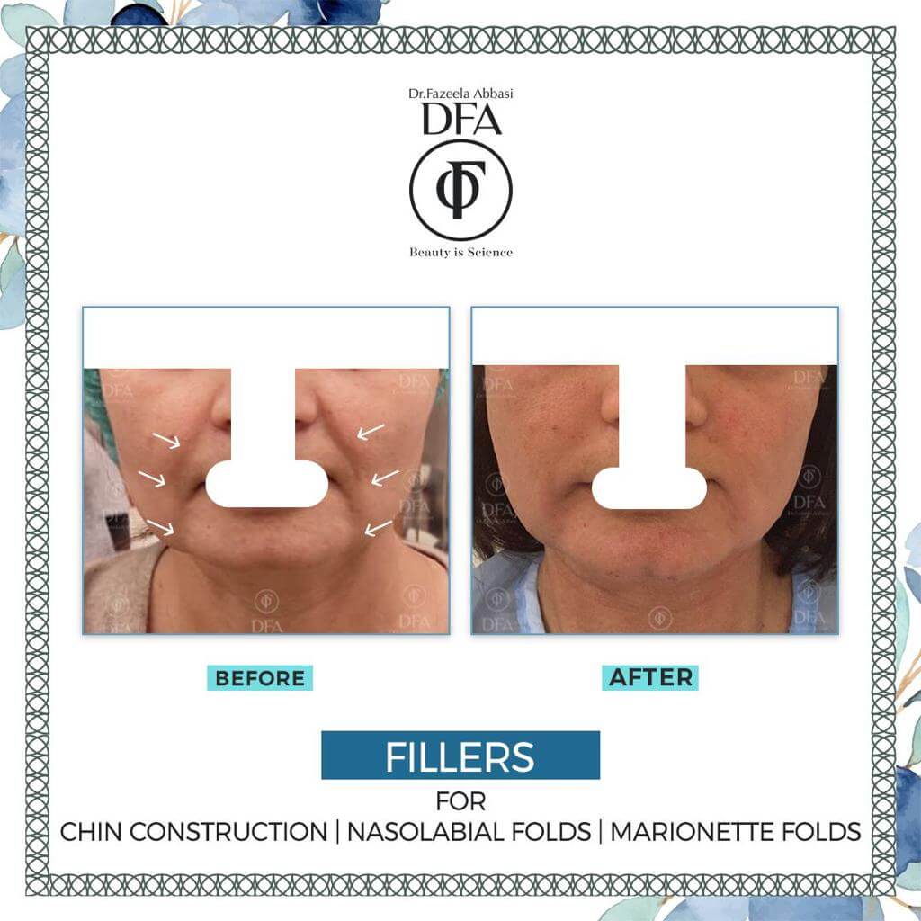 chin fillers, nose fillers in islamabad Dr. Fazeela