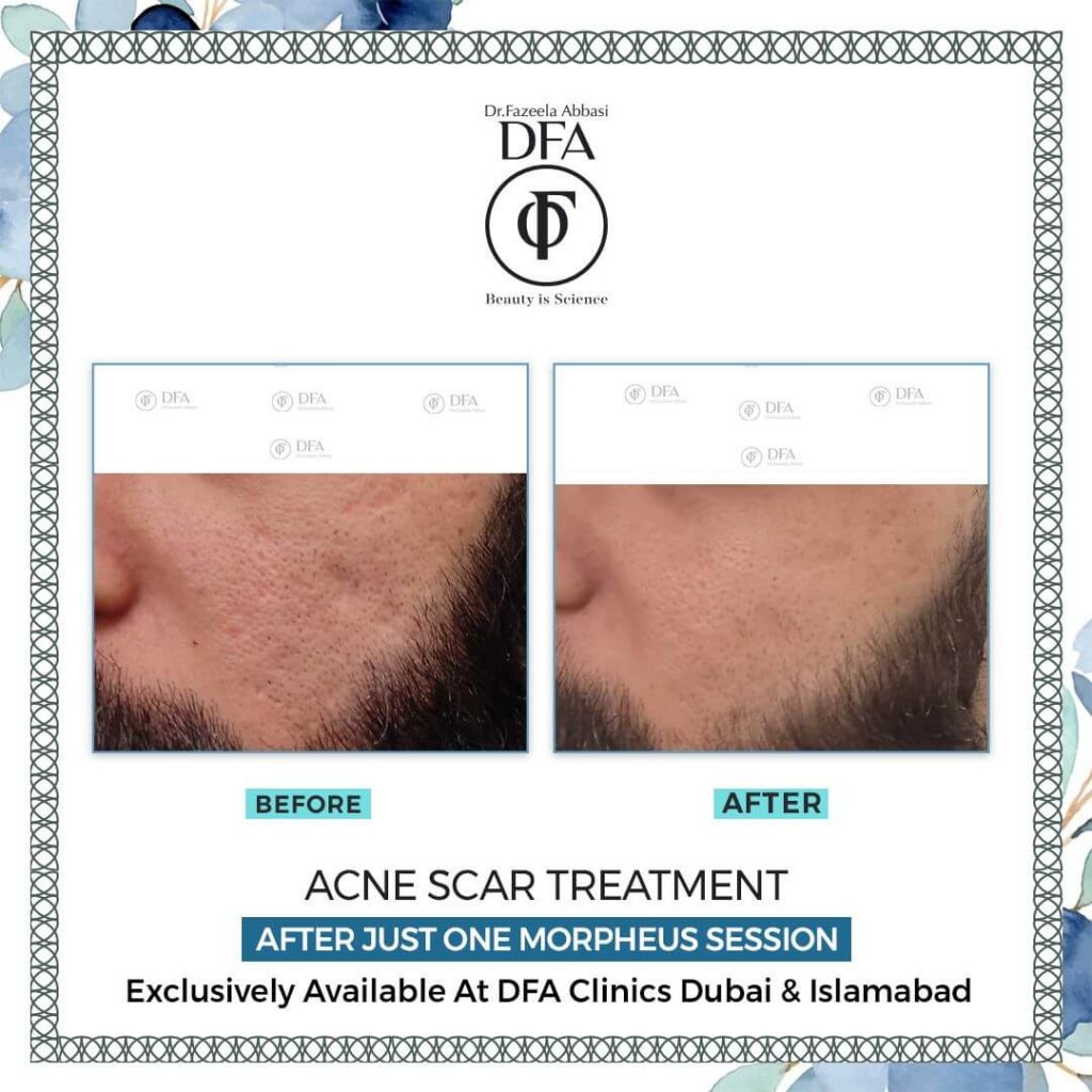 acne scar treatment after just 1 morpheus session in Islamabad Dr. Fazeela