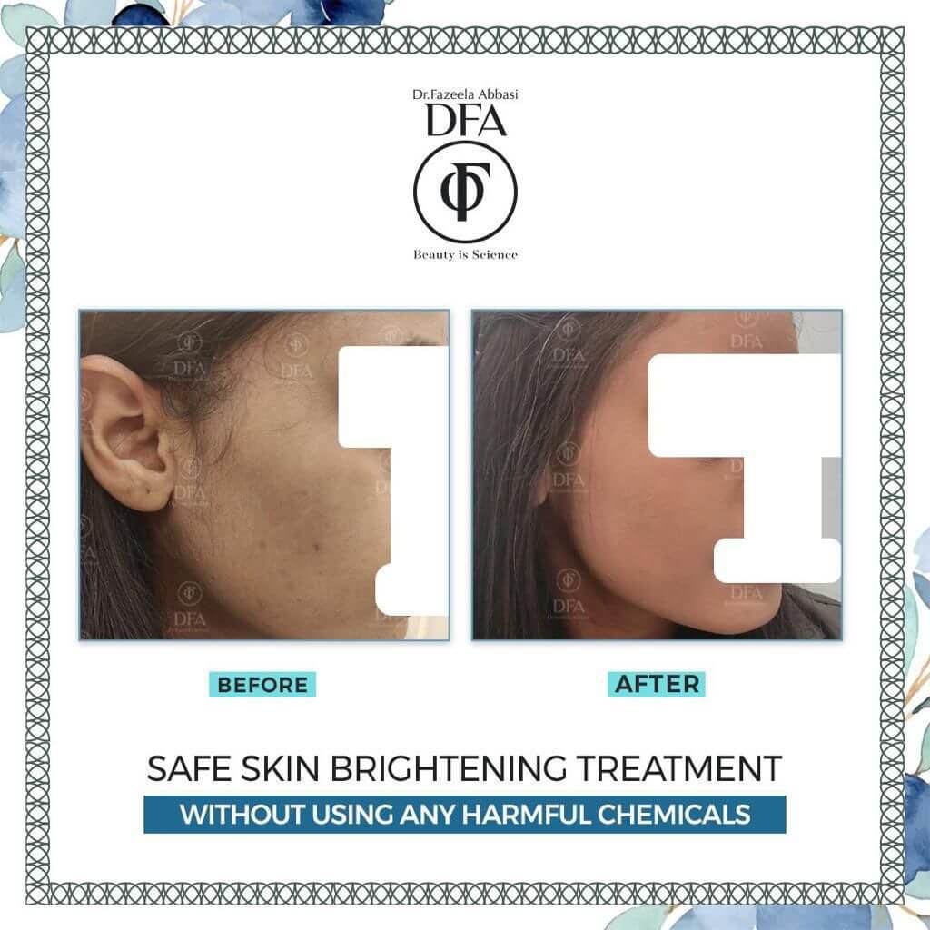skin brightening treatment without using any harmful chemicals in Islamabad Dr.Fazeela