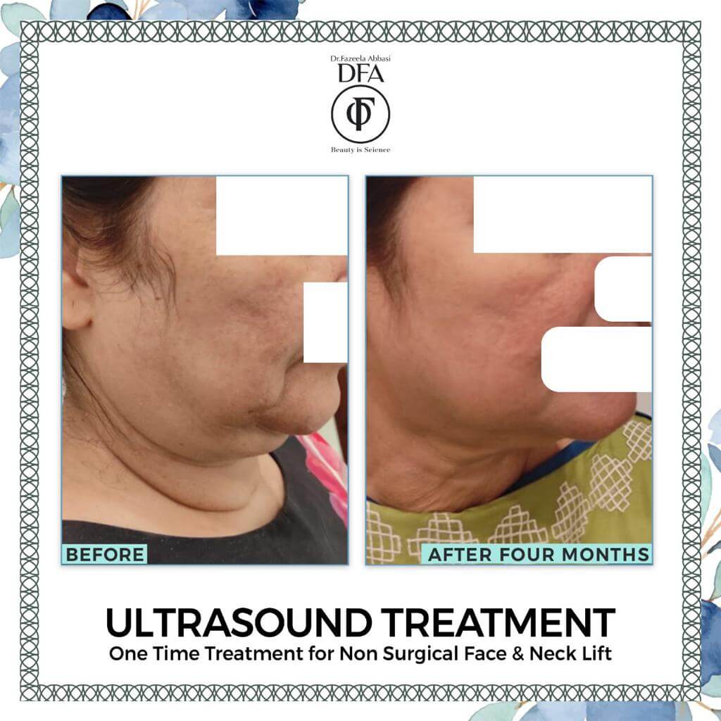 one time face and neck lift using ultra-sound treatment in islamabad Dr. Fazeela