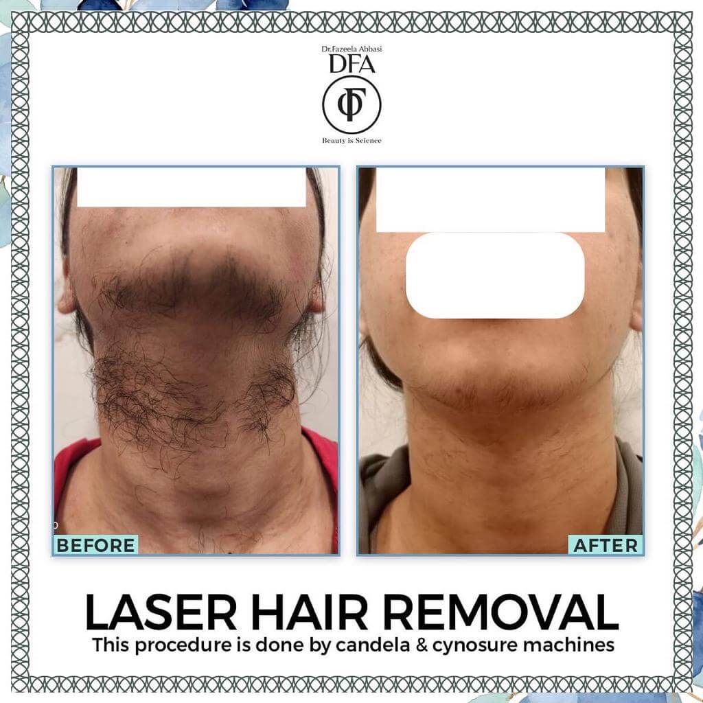 laser hair removal In Islamabad Dr. Fazeela