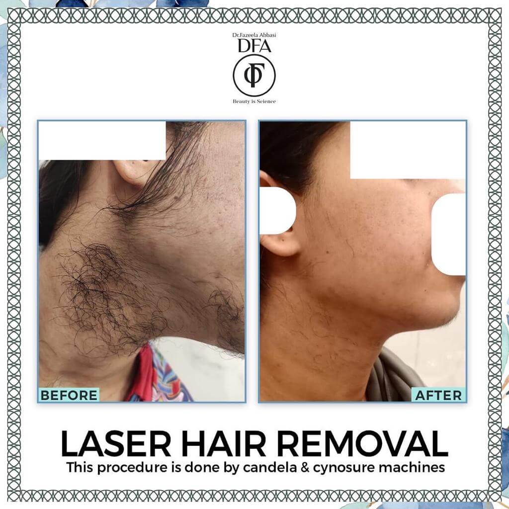 laser hair removal using candela and cynosure machine in Islamabad Dr. Fazeela