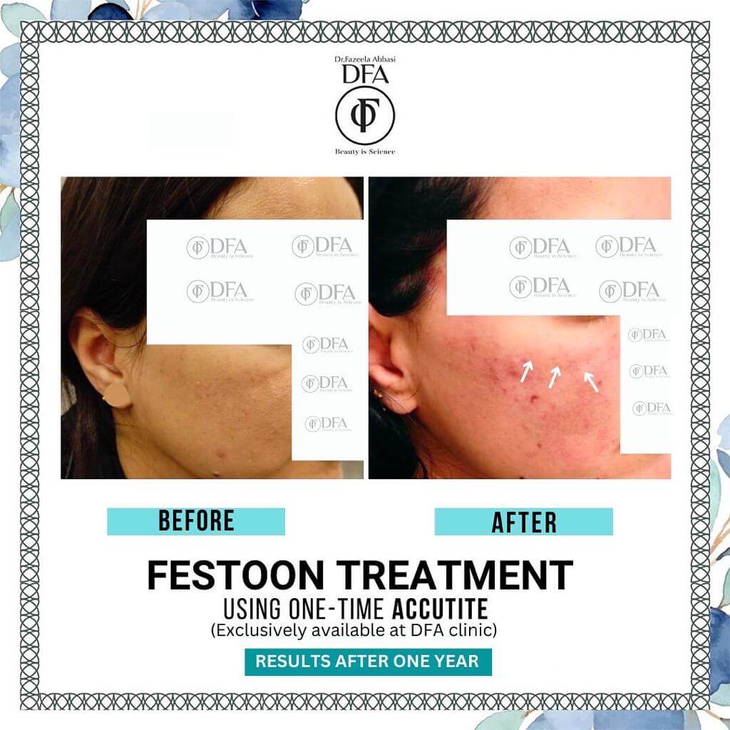 festoon treatment using one time accutite in Islamabad Dr. Fazeela