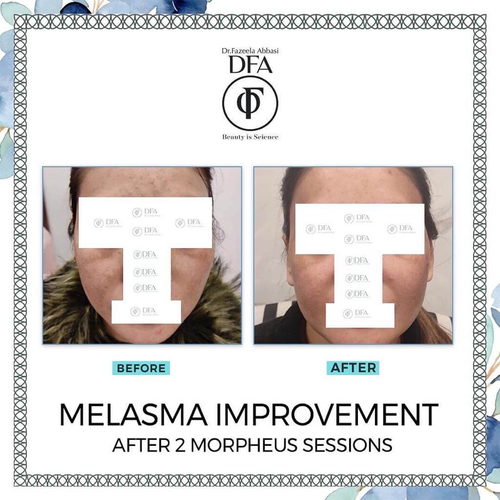 melasma improvement after 2 morpheus sessions in Islamabad Dr. fazeela