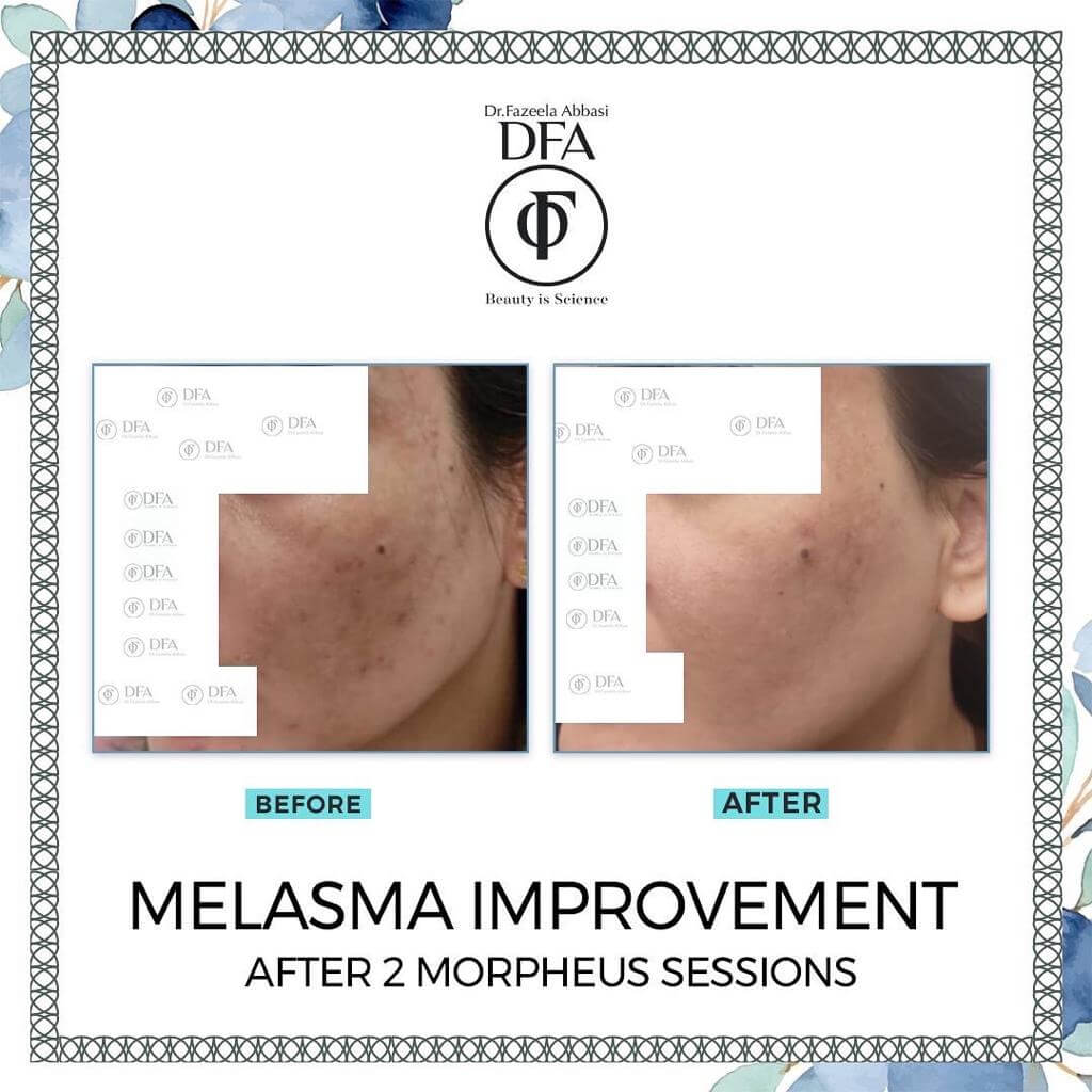 melasma improvement after just 2 morpheus sessions in Islamabad Dr. Fazeela