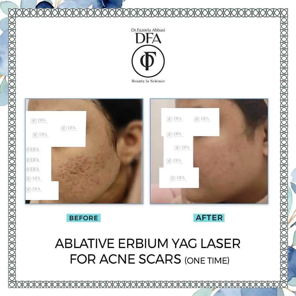 acne scars treatment in Islamabad Dr. Fazeela