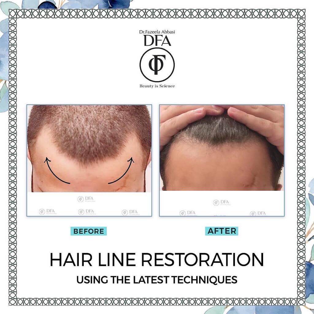 hair line restoration using latest techniques in Islamabad Dr. Fazeela