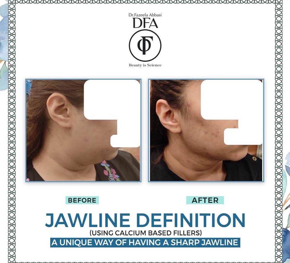 jawline definition using calcium based fillers