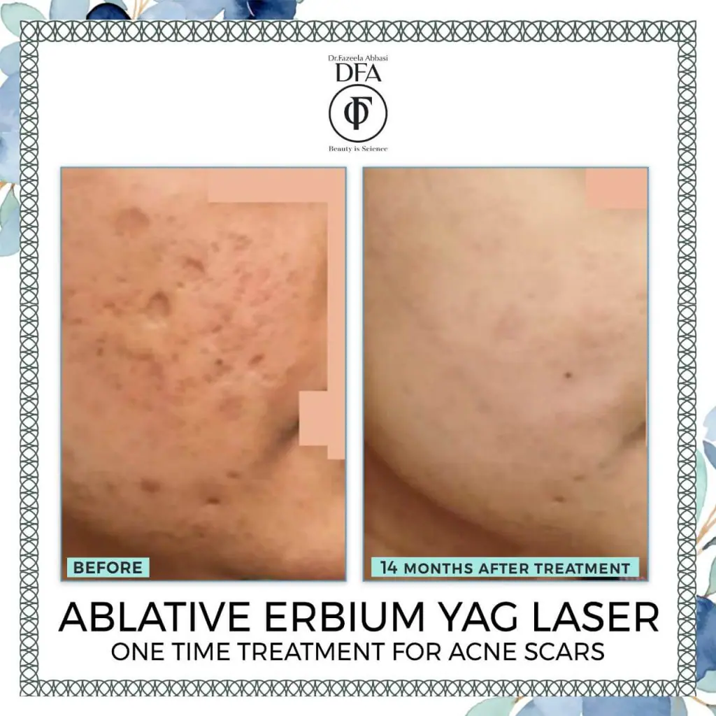 one time treatment for acne scars in Islamabad Dr. Fazeela