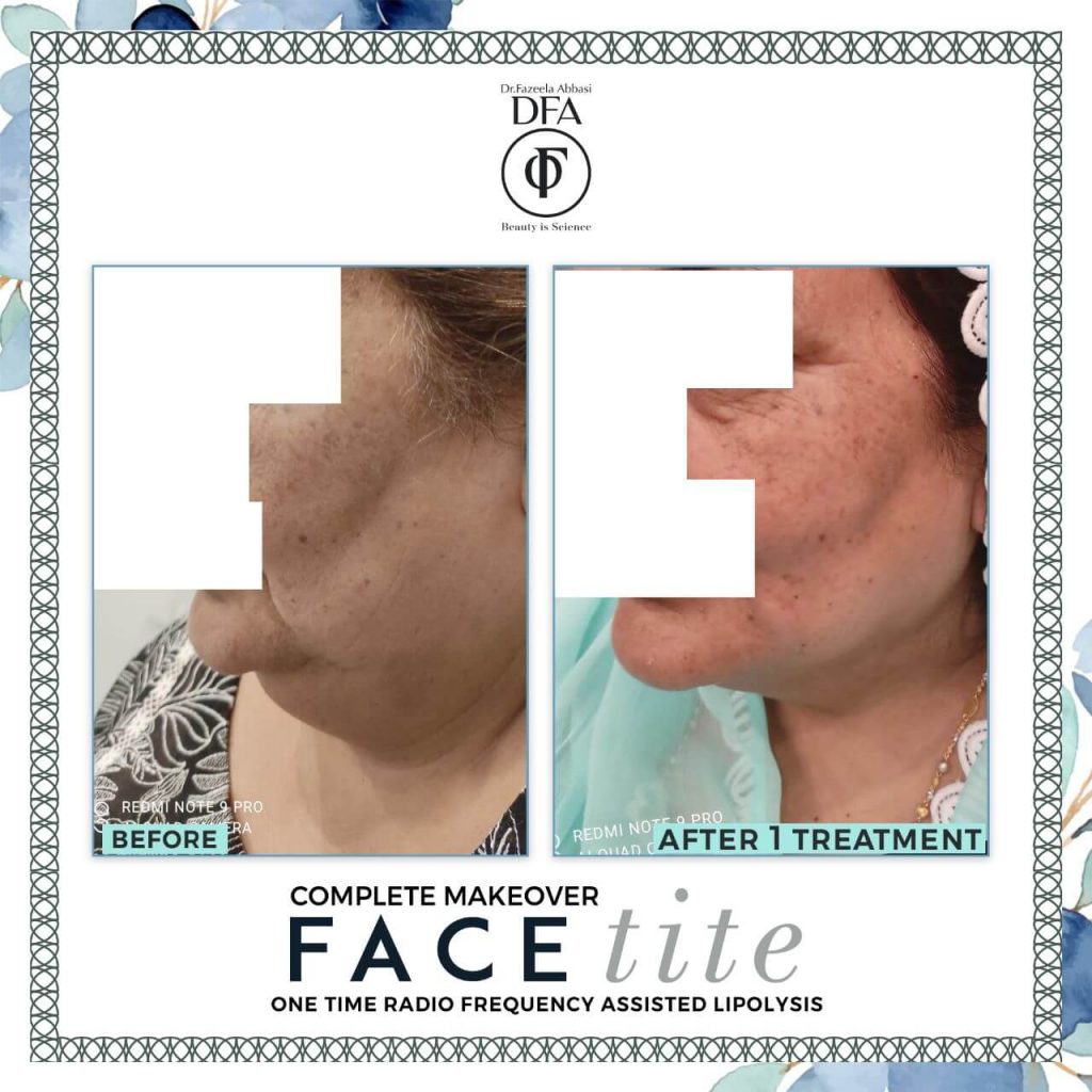 face tite makeover using TRF in Islamabad Dr. Fazeela