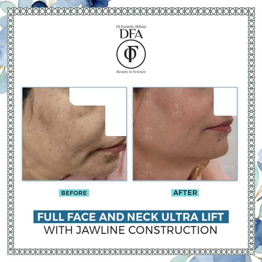 full face and neck ultra lift with jawline construction in Islamabad Dr. Fazeela