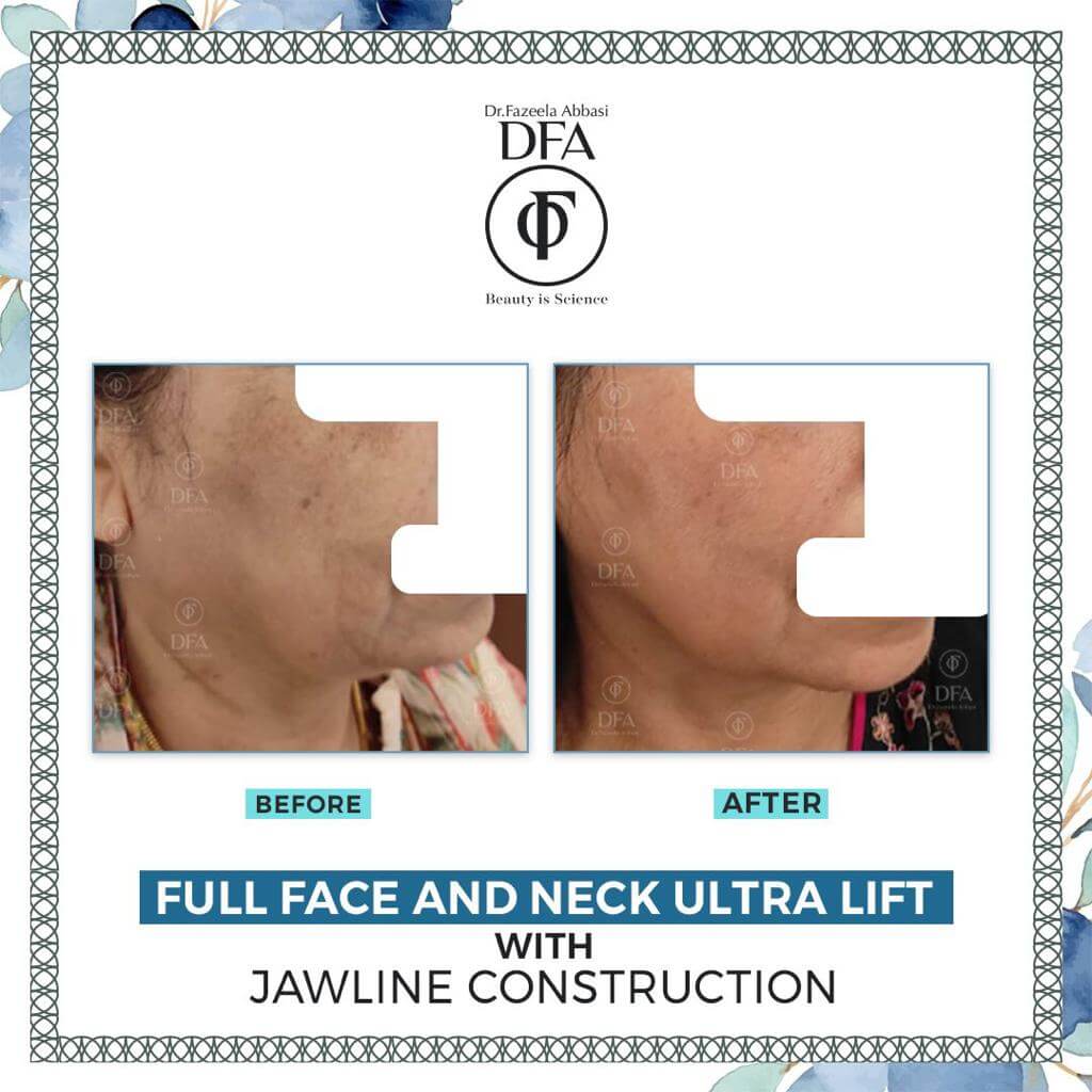 full face and neck lift with jawline construction in Islamabad Dr.Fazeela