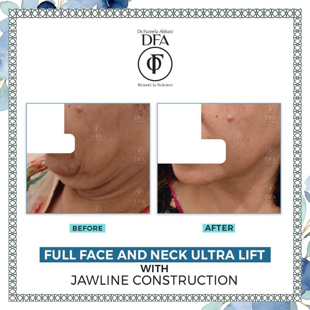 face and neck lift with jawline construction in Islamabad Dr. Fazeela
