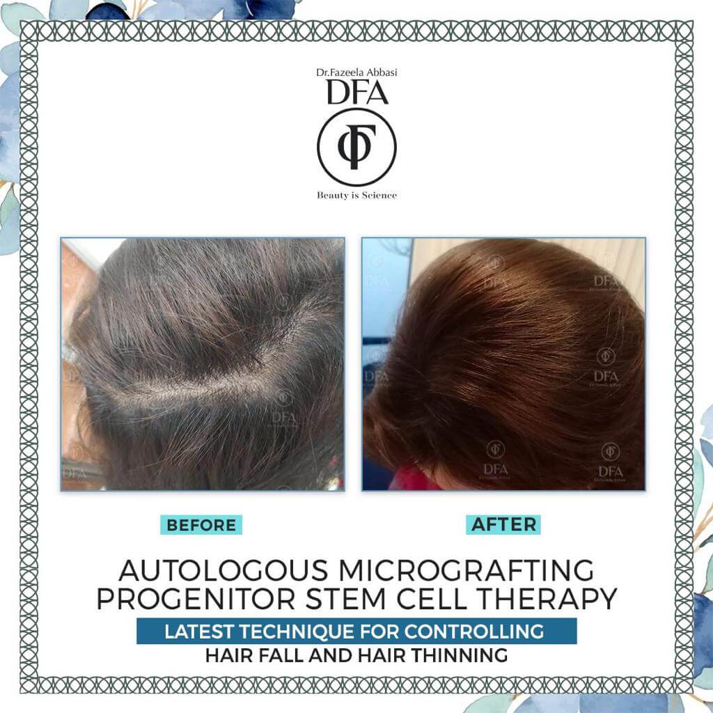 therapy for hair fall and hair thinning autologous micrografting progenitor stem cell or PRP therapy in Islamabad Dr. Fazeela