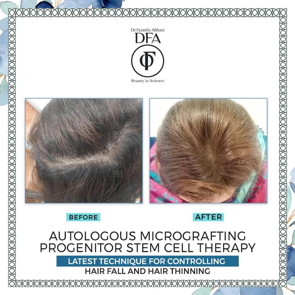 therapy for hair fall and hair thinning autologous micrografting progenitor stem cell or PRP therapy in Islamabad Dr. Fazeela