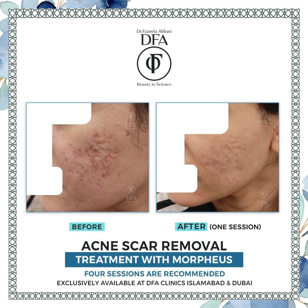 acne scar removal treatment with morpheus Dr. Fazeela