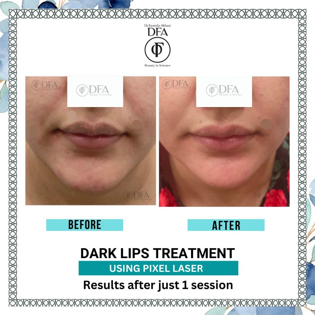 dark lips treatment using pixel laser Dr. Fazeela