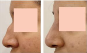 nose job in islamabad | nose fillers in islamabad