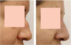 nose fillers in islamabad | non surgical rhinoplasty in islamabad