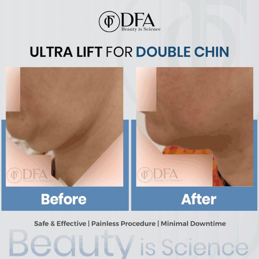 Ultra Lift for Double Chin