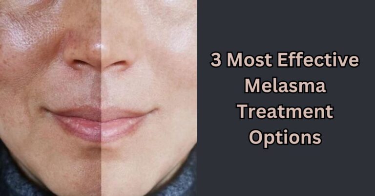 3 Most Effective Melasma Treatment Options