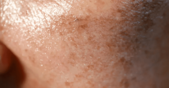 Dealing with Hyperpigmentation in Islamabad