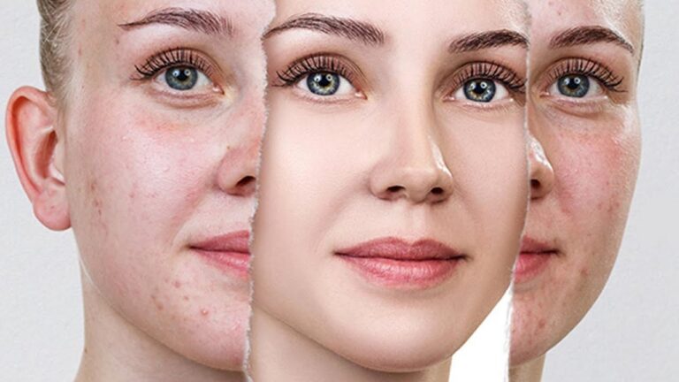 Laser treatment for Acne Scars Cost in Islamabad