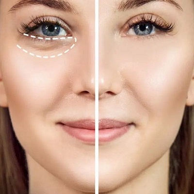 How to Remove Eye Bags Permanently?