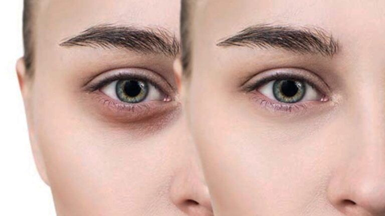 How to Remove Dark Circles Under Eyes Permanently