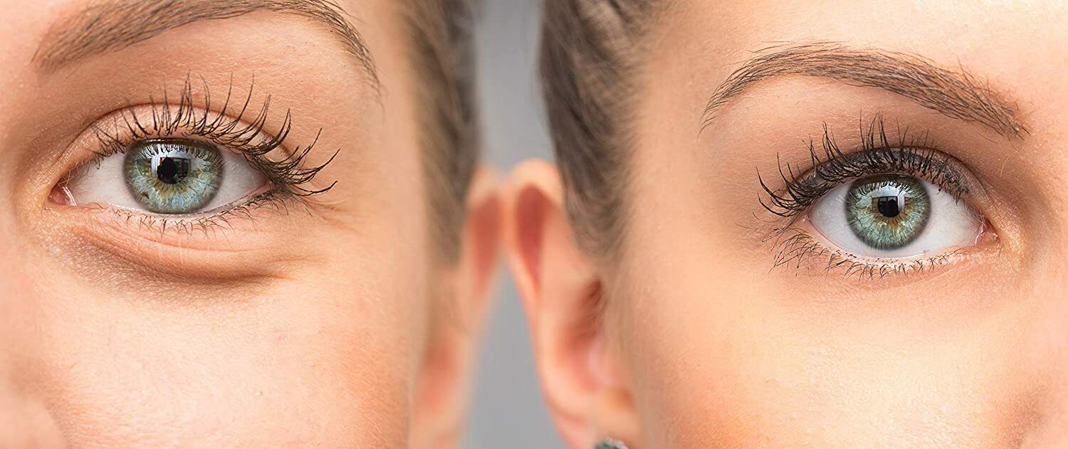 How to Remove Eye Bags Permanently