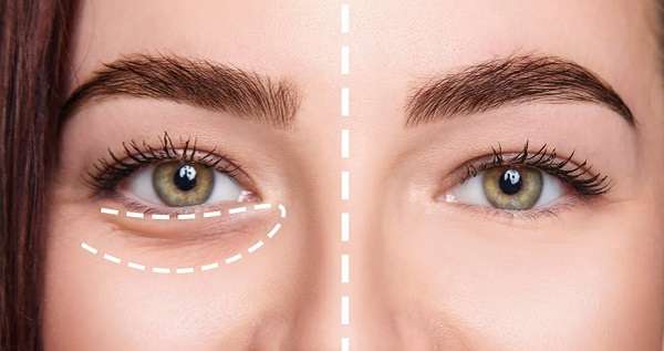 How Quickly Do Under Eye Fillers Work?