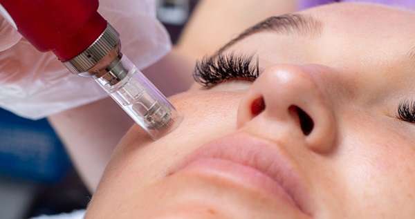 Benefits of Microneedling with Prp