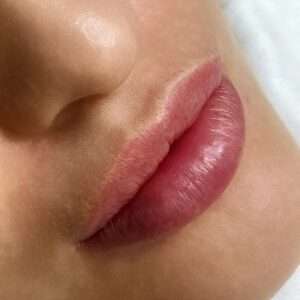 Lip Pigmentation Removal