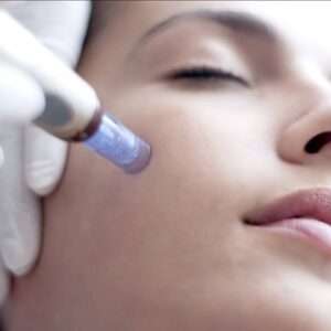 Microneedling for Face