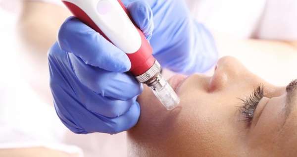 Microneedling for Face Benefits