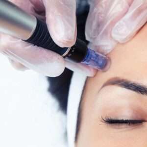 Microneedling with PRp