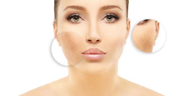 Does Glutathione Lighten Dark Spots
