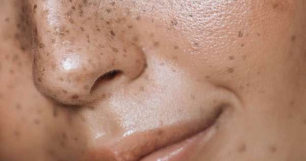 Hyperpigmentation Treatment for Black Skin
