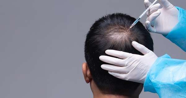 PRP And Exosomes For Hair Loss