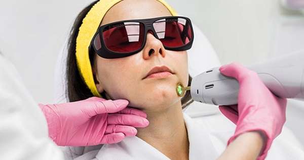 Permanent Facial Hair Removal for Women