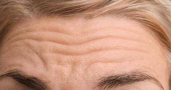 Treatment for fine lines on forehead