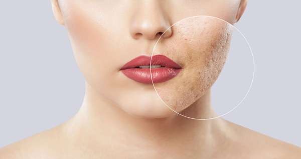 Best treatment for pigmentation on face in Pakistan