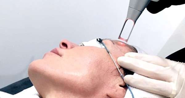 Does Pico Laser Treatment Remove Freckles