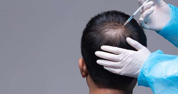 How Effective is Exosome Treatment for Thinning Hair