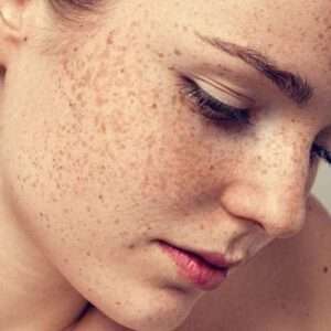 Pigmentation on face in Pakistan