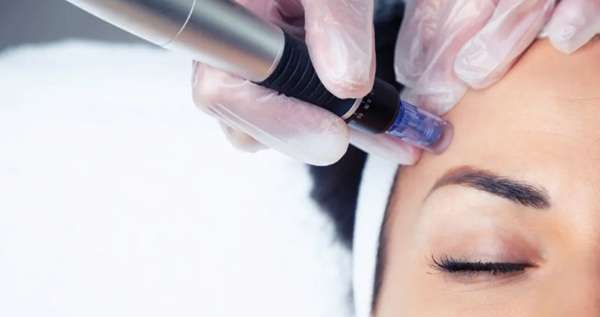 Can Microneedling Help With Fine Lines & Wrinkles?