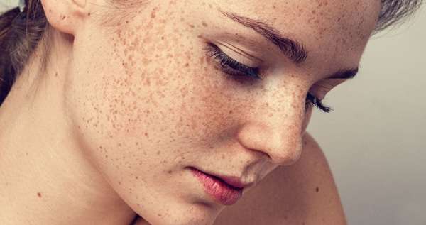 How to Differentiate Melasma from Freckles?