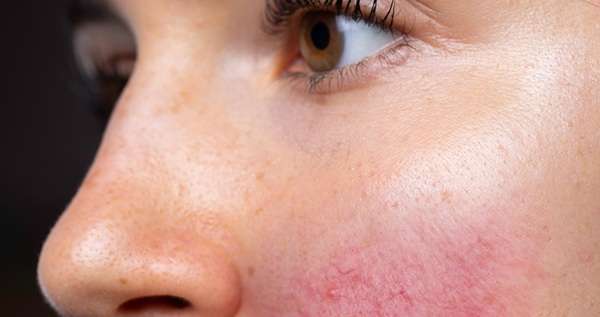 How to Get Rid of Rosacea Permanently?