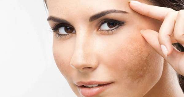 Best Treatments for Melasma on the Face