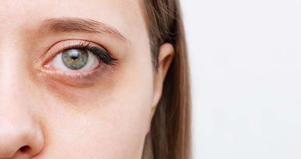 How to Avoid Dark Circles Under the Eyes